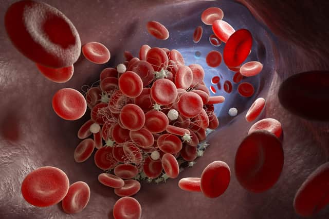 There are two main types of blood clots. Arterial clots are those that form in the arteries, and venous clots are those that form in the veins, explains Dr Oliver Guttmann, consultant cardiologist at The Wellington Hospital, part of HCA Healthcare UK.
