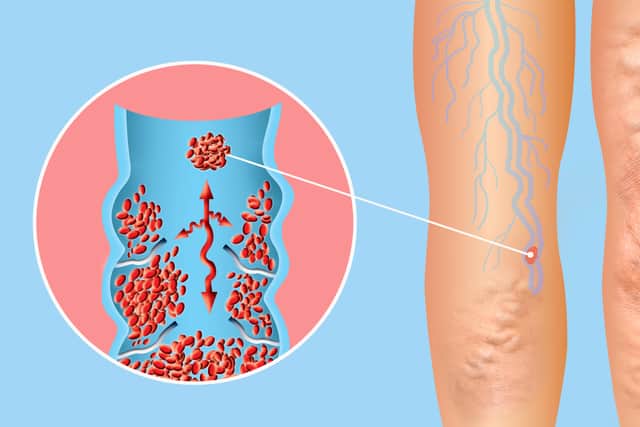 “The most common one that people often talk about is deep vein thrombosis (DVT),” says Guttmann. “These are the ones that people often have after they go on a long haul flight, for example, or after surgery.”If there’s prolonged periods of immobility people can get clots in their veins, and often they get blood clots in the veins in their legs.”