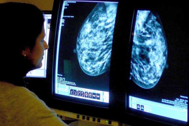 A mammogram is a breast x-ray which looks for signs of cancer, according to the charity Breast Cancer Now.