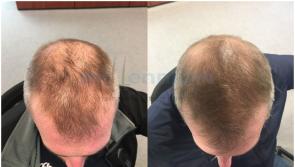 Millennium Hair Restoration Clinic - offering life changing, confidence building services with great success