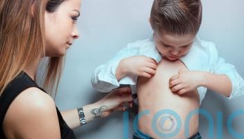 6 subtle warning signs of measles in children &ndash; and how to prevent it