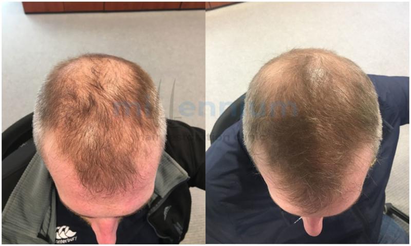 Millennium Hair Restoration Clinic - offering life changing, confidence building services with great success